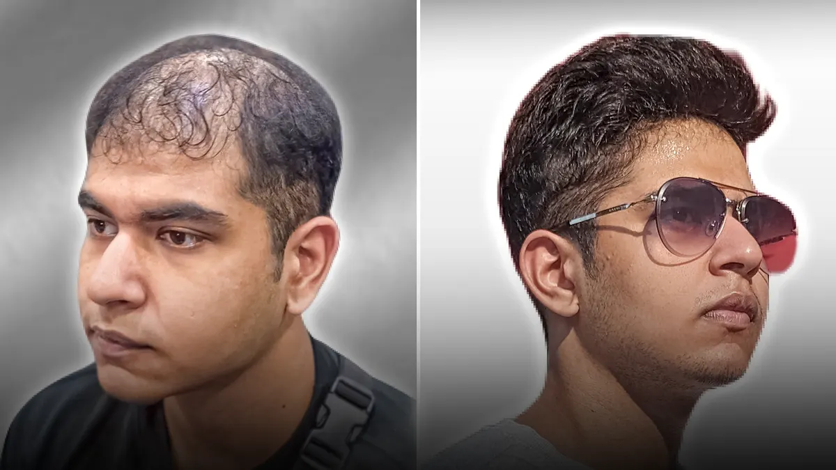 Client before and after: thinning crown, then a full swept-back system.