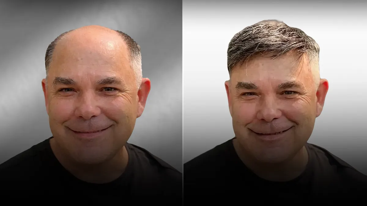 Client before and after: receded hairline, then a restored natural front.