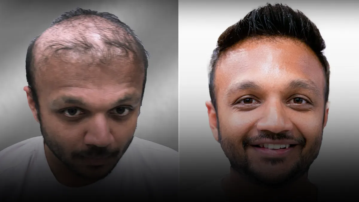 Client before and after: bare crown, then a textured natural finish.
