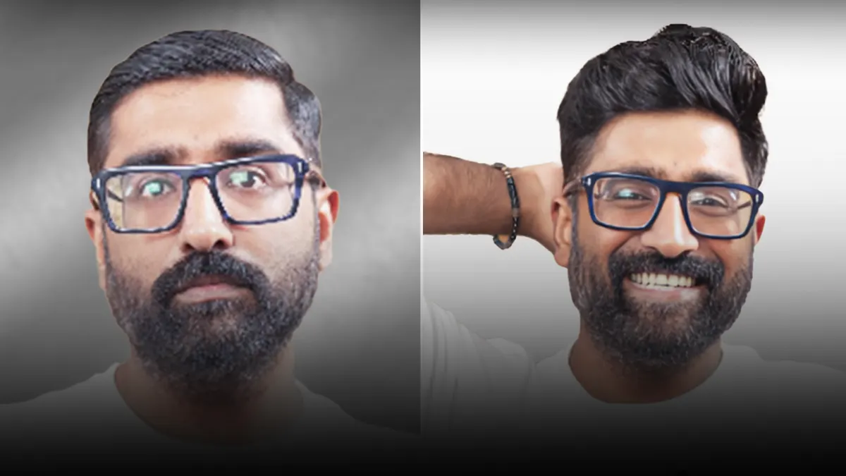 Client before and after: advanced hair loss, then a matched hairline.