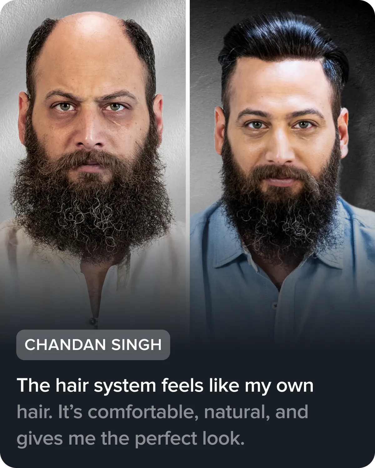 Chandan Singh, before and after his hair system. He says: “The hair system feels like my own hair. It’s comfortable, natural, and gives me the perfect look.”