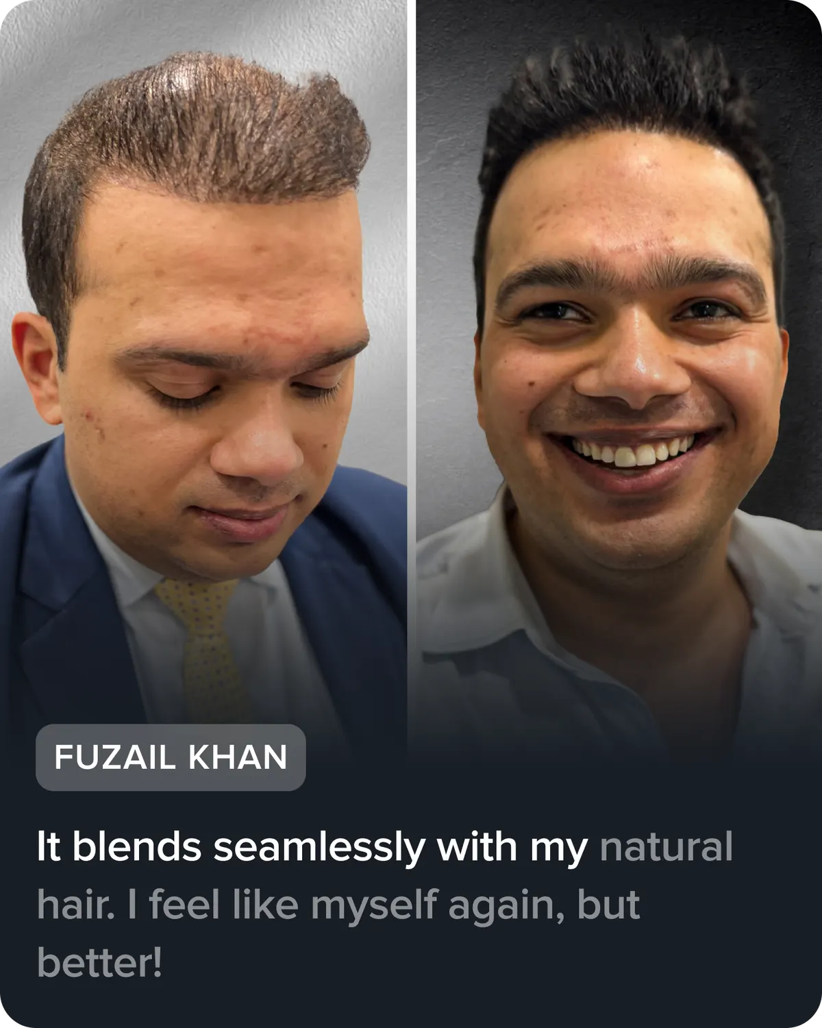 Fuzail Khan, before and after his hair system. He says: “It blends seamlessly with my natural hair. I feel like myself again, but better!”
