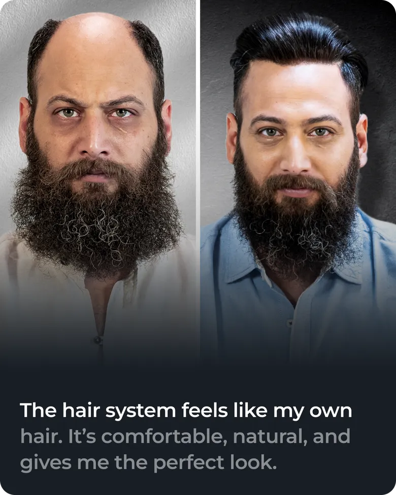 Client hair replacement result