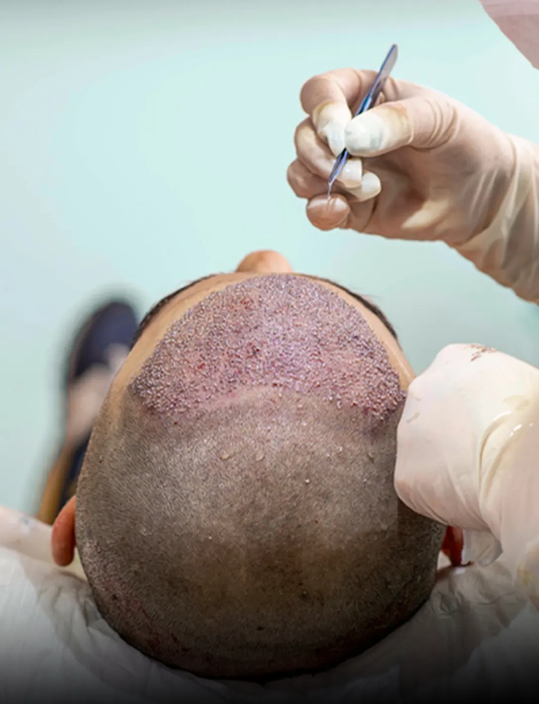 A transplanted front hairline shortly after the procedure.
