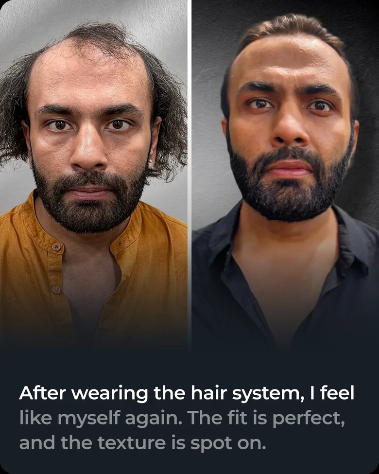 Stick-on hair system client transformation