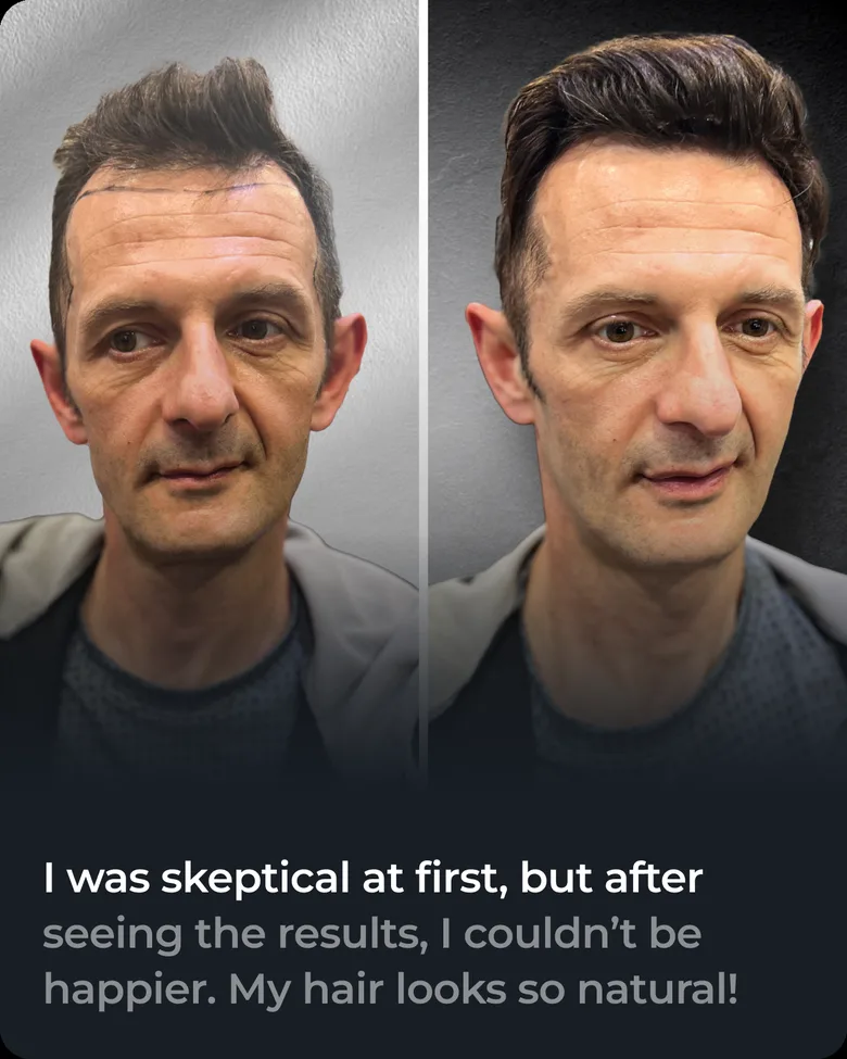Stick-on hair system client transformation