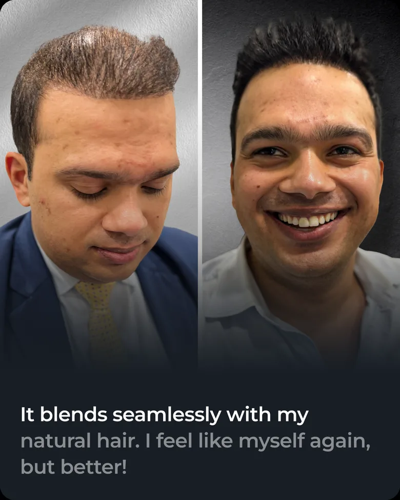 Stick-on hair system client transformation