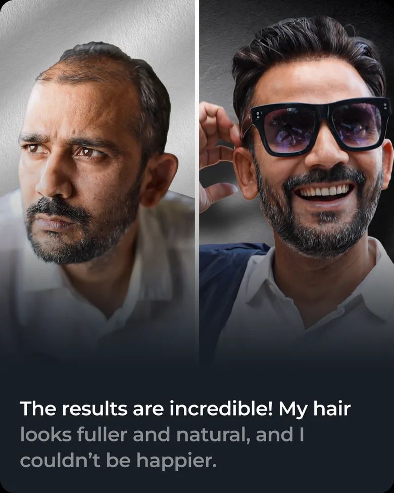 Stick-on hair system client transformation